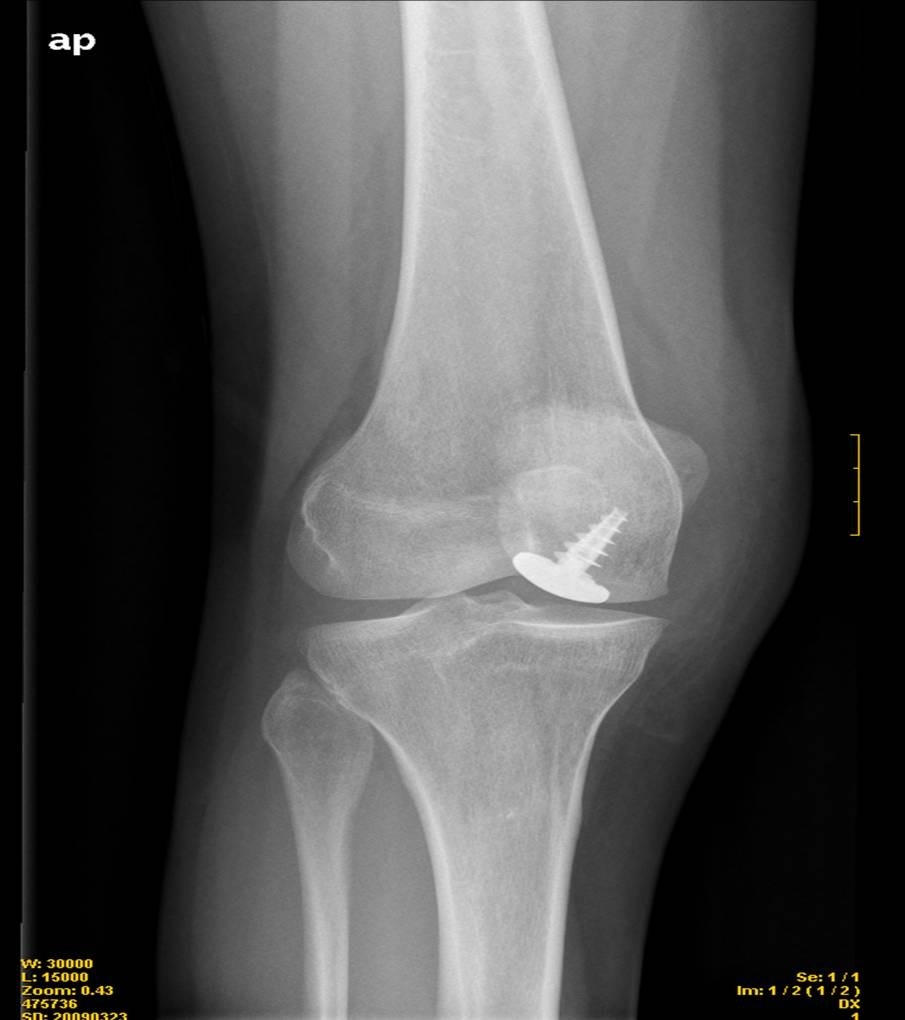 Radiografia d'una artroplastia parcelar de genoll